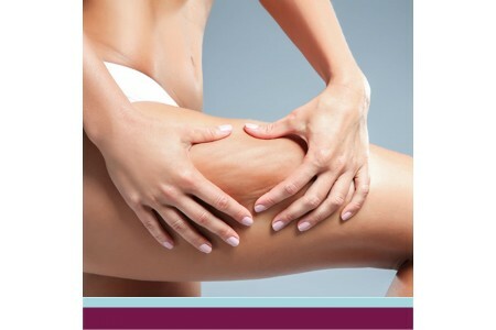 Lipedema: o impacto na autoestima e como a estética pode ajudar