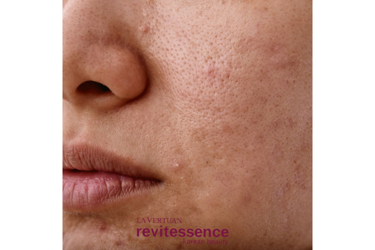 Oleosidade, Acne e Manchas: Um Guia Completo para Cuidar da Pele Oleosidade, Acne e Manchas: Um Guia Completo para Cuidar da Pele