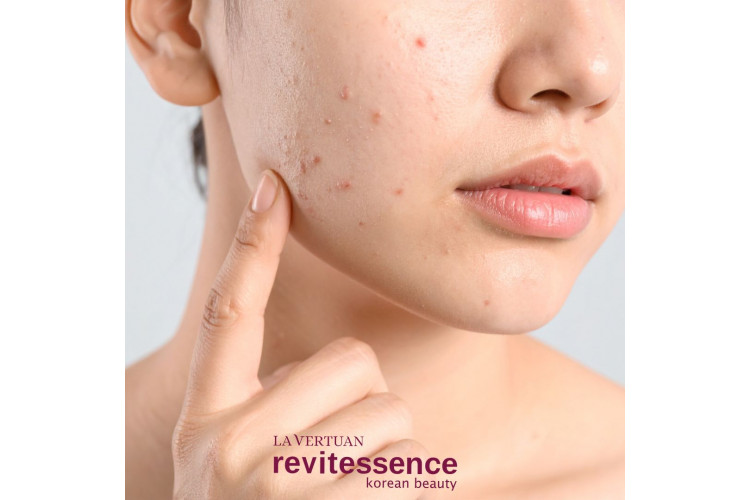 Como o Porcelain Glow Cream ajuda na acne, nos poros e na textura irregular da pele