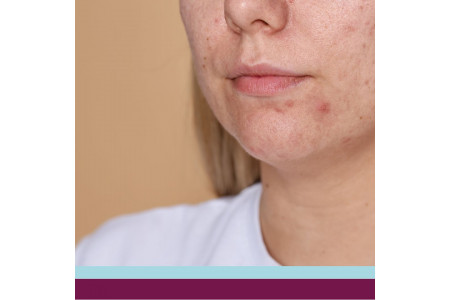 Microagulhamento Biológico para Redução de Poros Dilatados e Redução da Oleosidade da Pele 